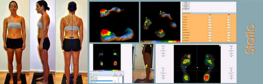 What Is a Gait and Pressure Analysis Treadmill?