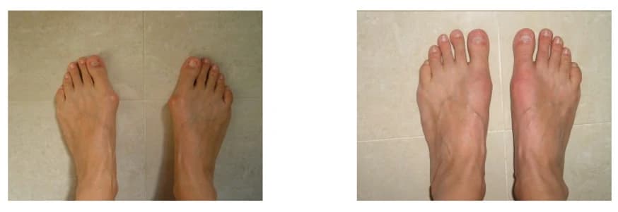 Bunion Surgery: Pre and Post Op