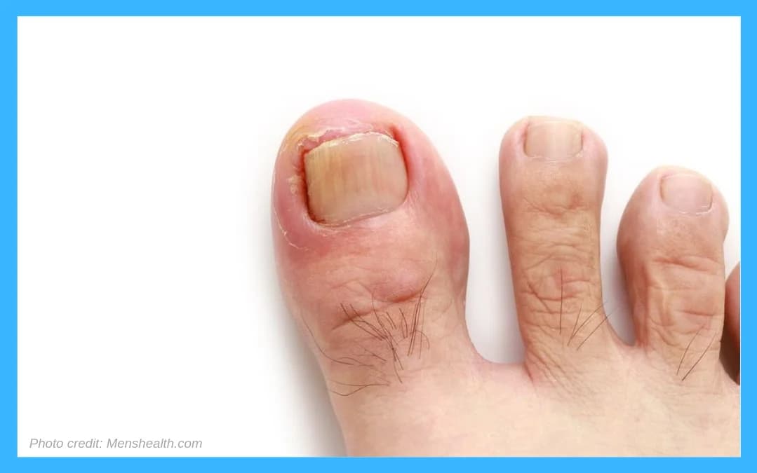 Ingrown Toenail Surgery Benefits