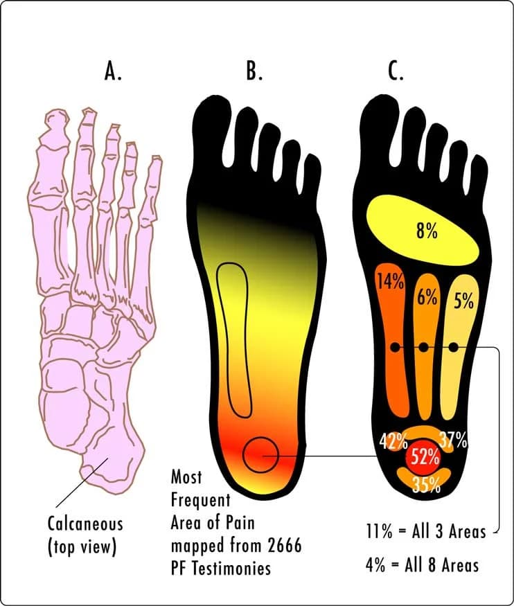 Plantar Fasciitis Case History