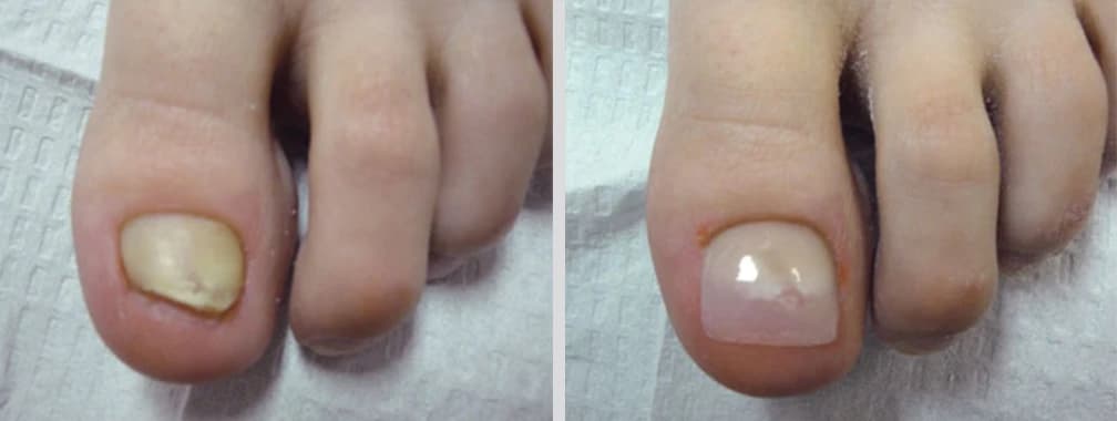 Introducing New Nail Technology at FALL - Podiatry health article from FALL Clinic Perth