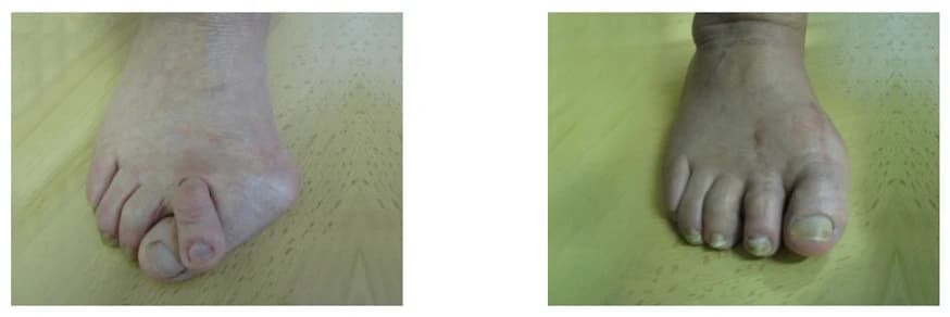 Hammertoe & Bunion Surgery: Before and After
