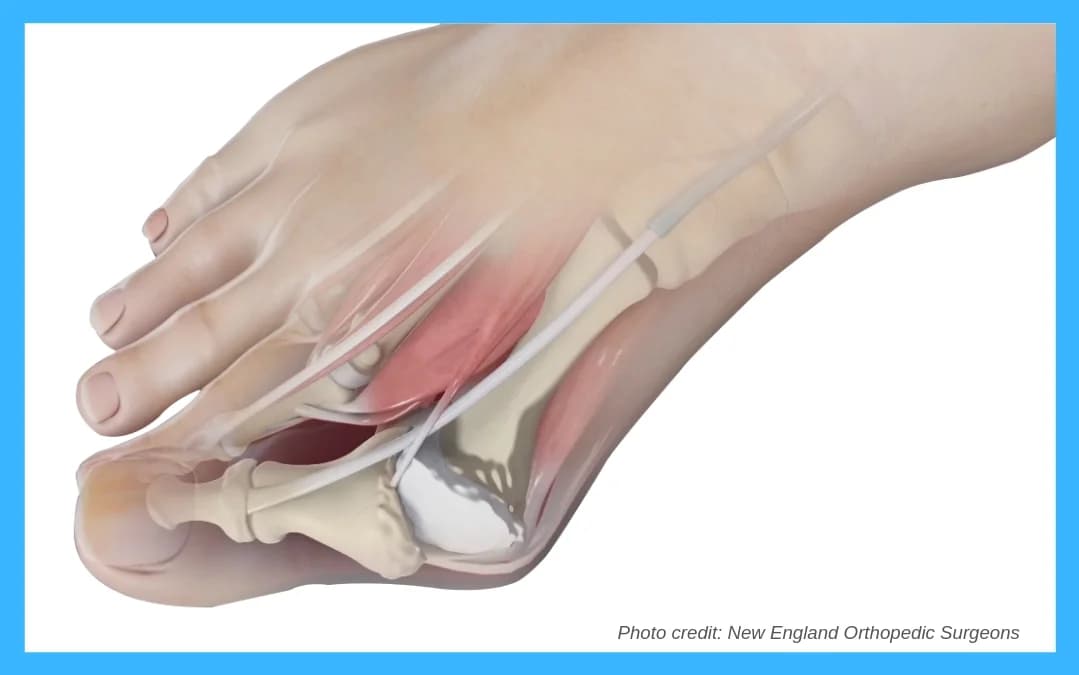 Bunion Removal: Before and After