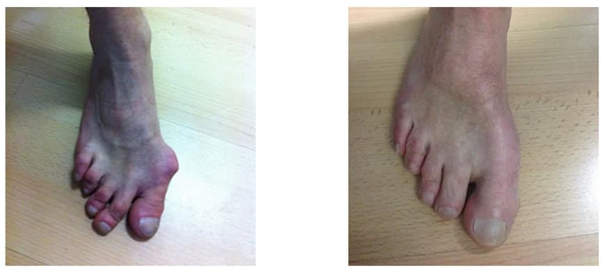 Forefoot Reconstruction Surgery: Before and After Photos