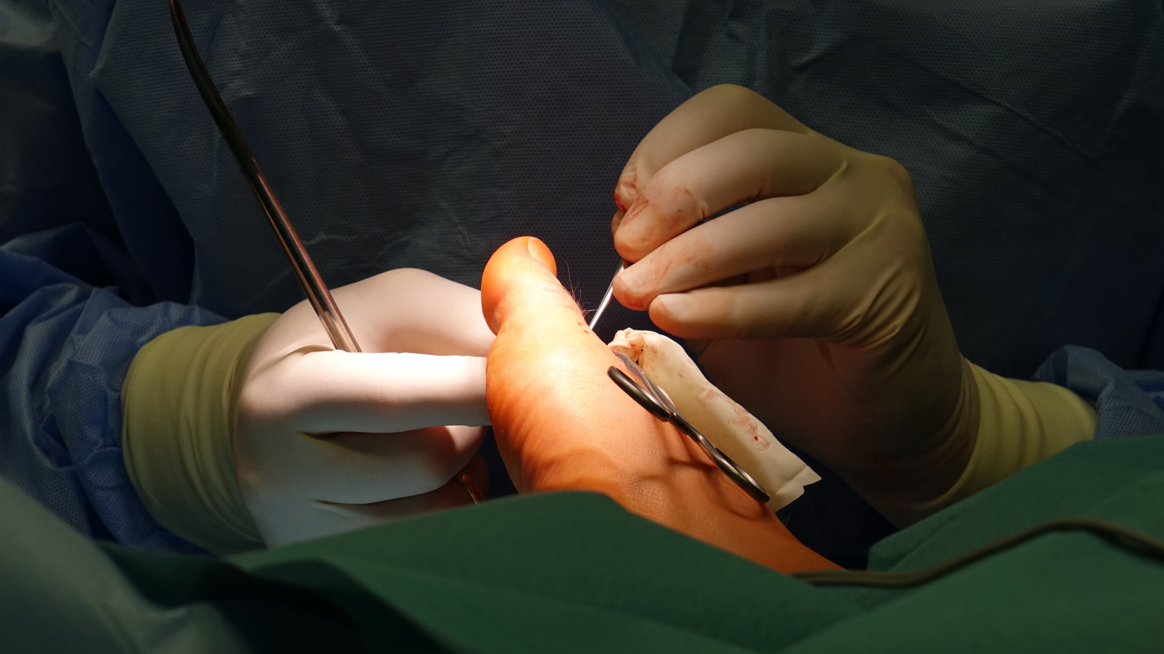 Should I treat my ingrown nail permanently? Updated
