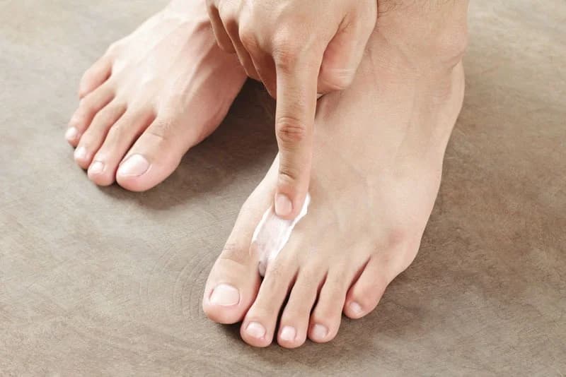 Tinea pedis/Athlete’s foot
