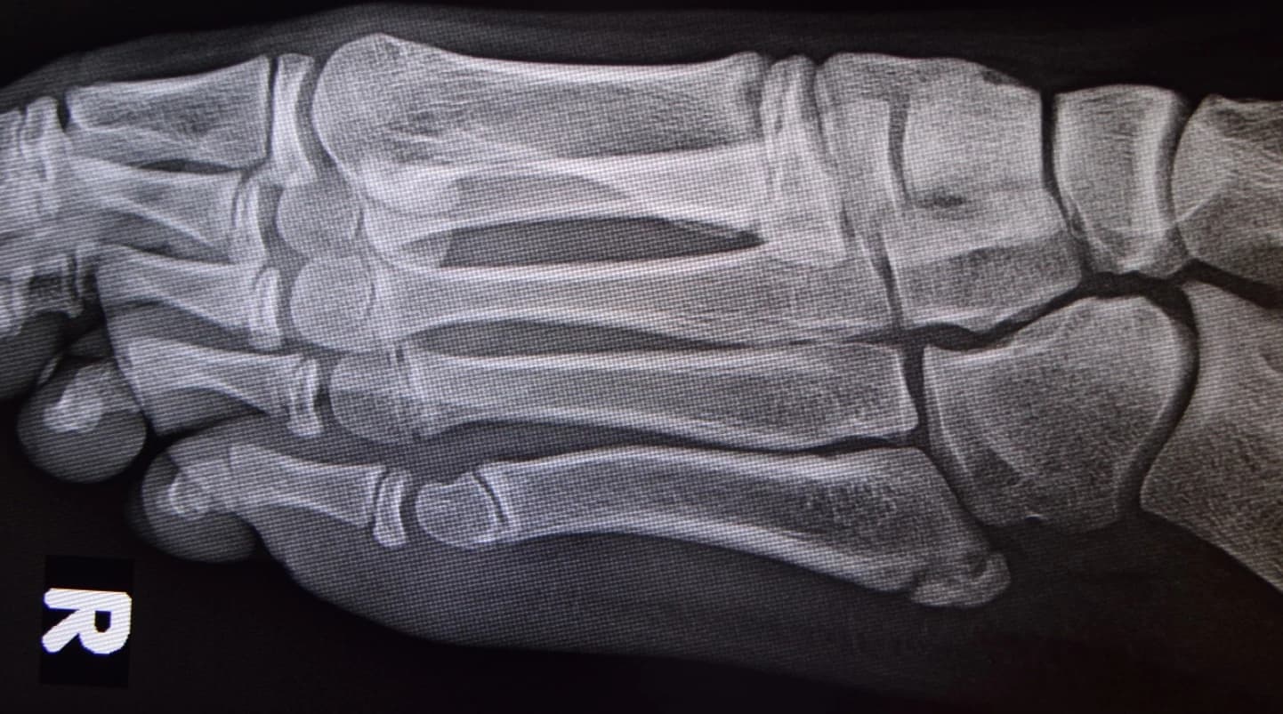 Why is my child getting pain on the outside of their foot (Iselin's Disease)?