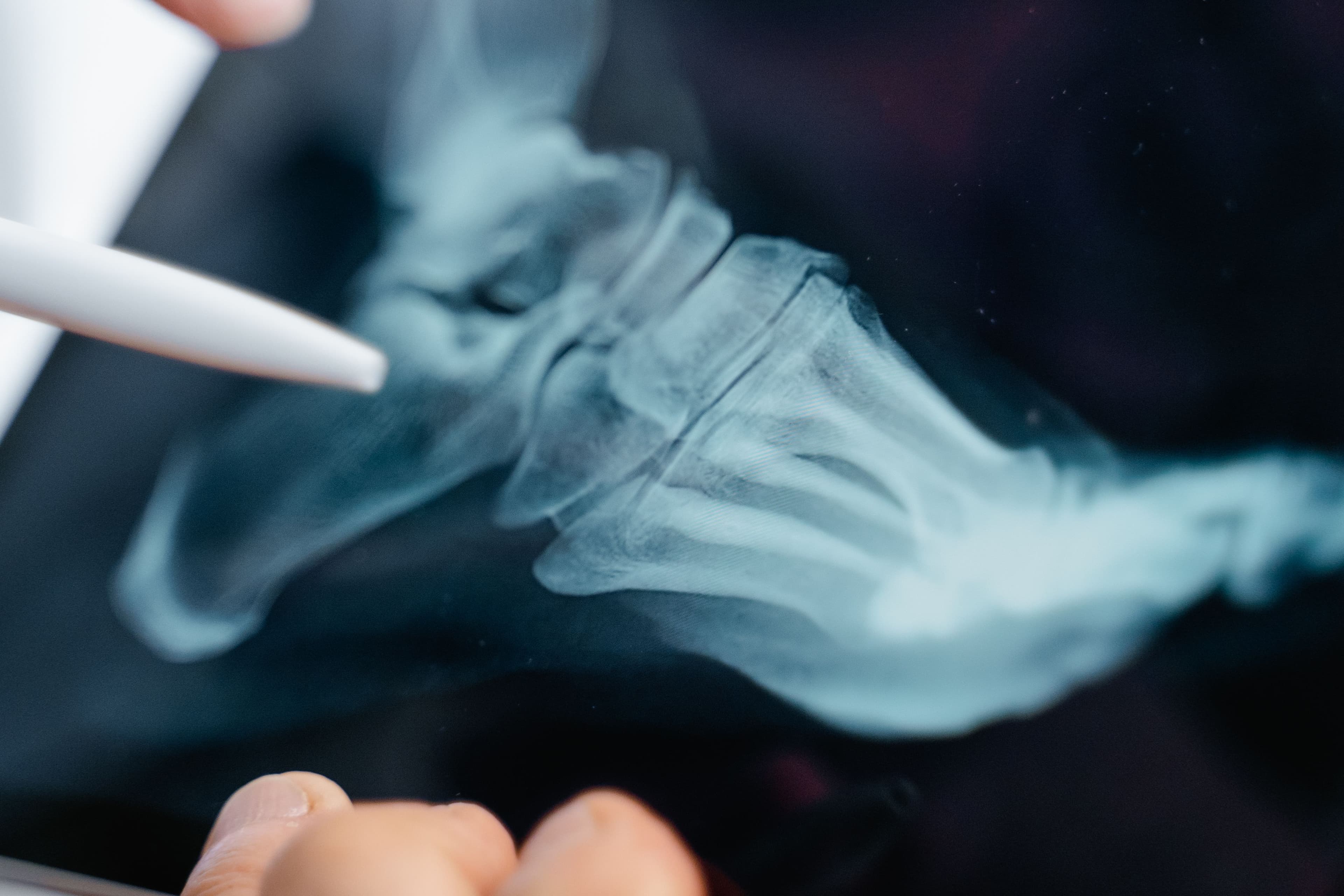 What if your nail problem comes from an underlying bone problem? Updated