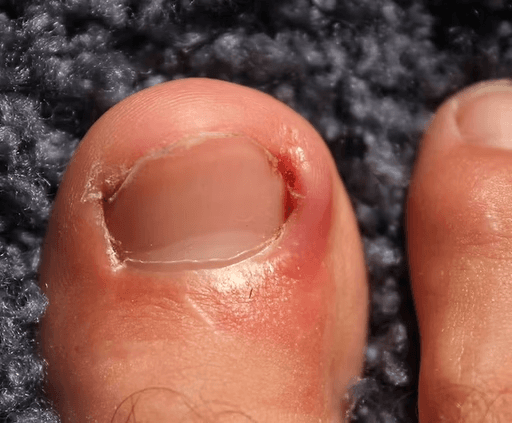 Ingrown Toenail